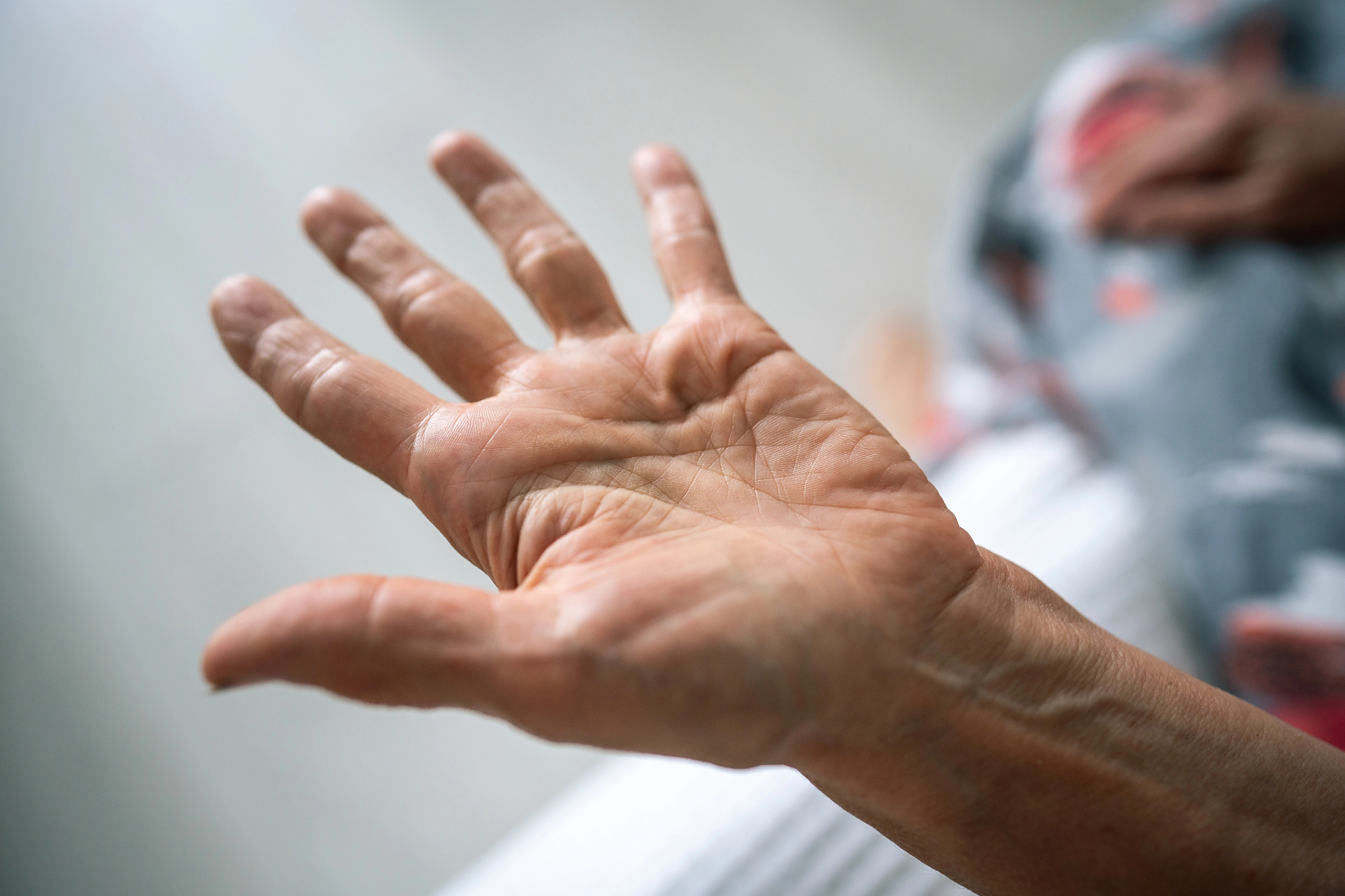 Podobnost med diagnozo dupuytrenova kontraktura in sindromom  krpalnega kanala